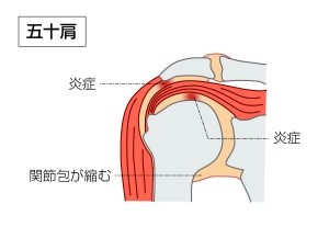 酸 注射 肩 ヒアルロン